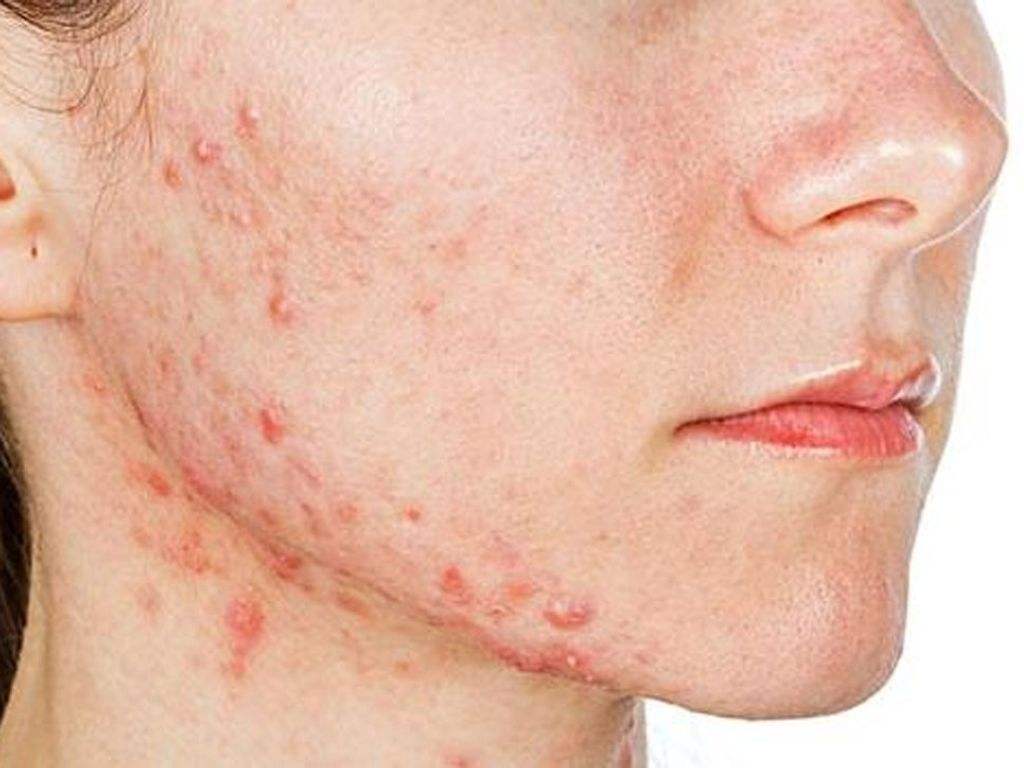 جوش‌های التهابی (Papules)