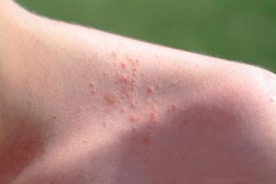 جوش‌های ناشی از گرما (Heat Rash)