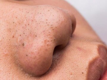 جوش‌های سرسیاه (Blackheads)